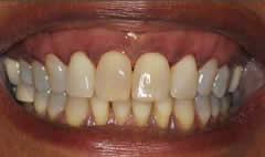 1after