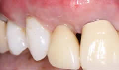 2after